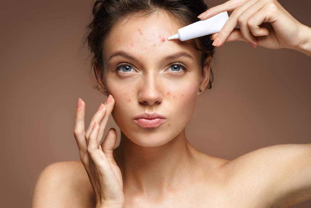 The Best Ways to Prevent Acne: Your Comprehensive Guide image