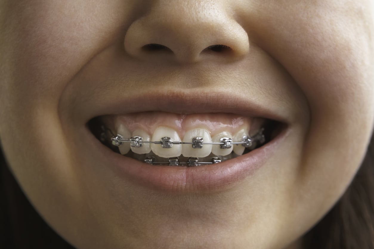 10 Signs Your Child May Need Braces image