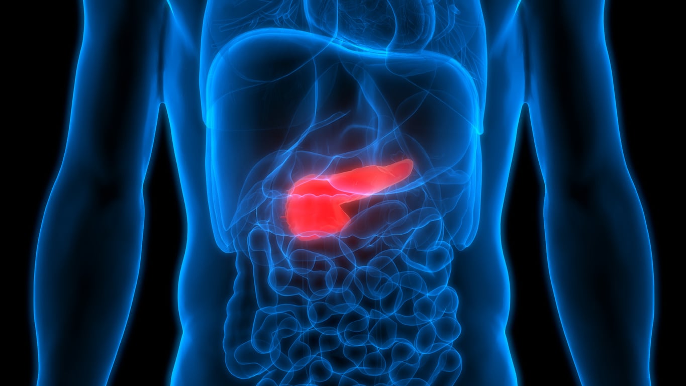 Frequently Asked Questions about Acute Pancreatitis image